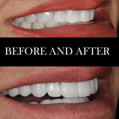 smile rejuvenation before & after Jason Cellars, DDS