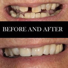We gave him 5 beautiful veneers to close the space while keeping his original color and feel.