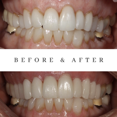 Our patient wanted more natural veneers
