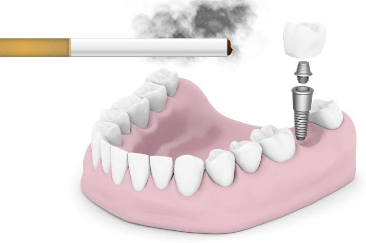 Am I a Candidate for Dental Implants If I Smoke?