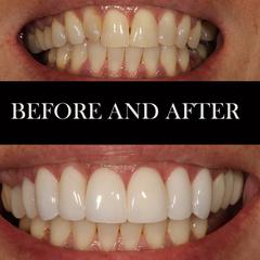 porcelain veneers to get her teeth to a more fitting size