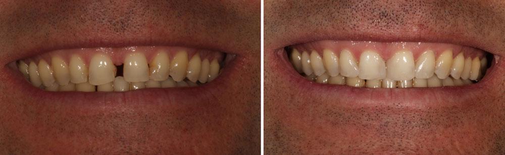 cosmetic veneers to fix gap in teeth - Huntington Beach dentist