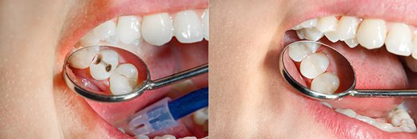 holistic dentist in Huntington Beach: No mercury filling