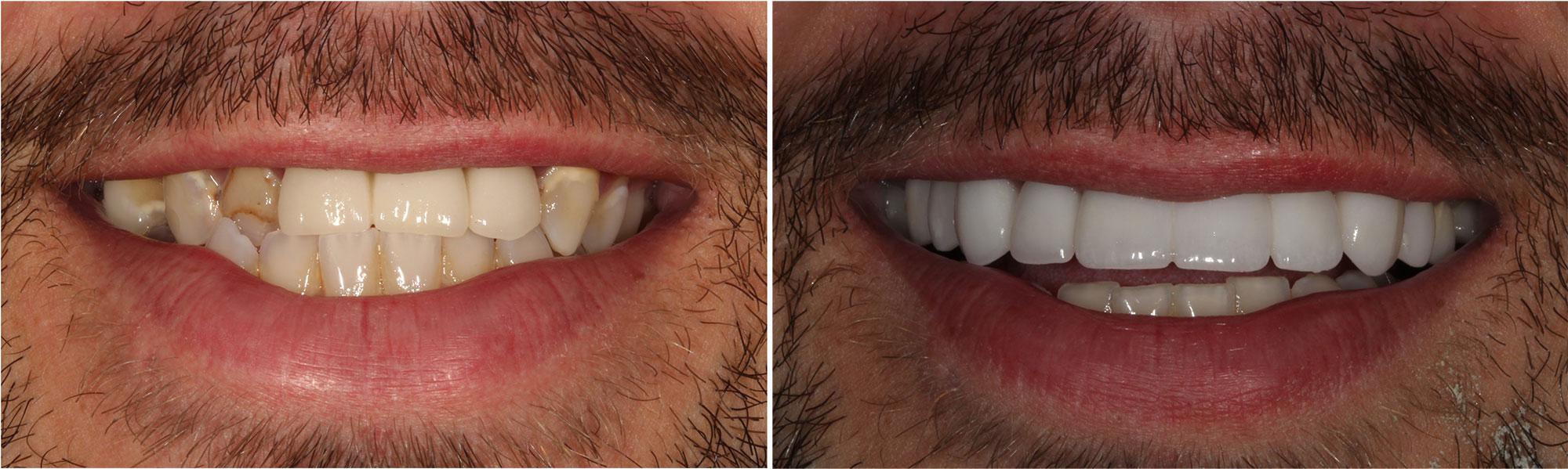 Jason Cellars, DDS used a combination of crowns and veneers to fix this patient's decay