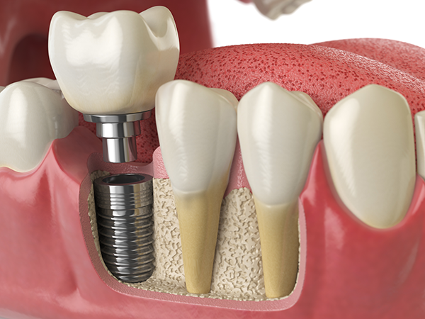 dental implant placement in Huntington Beach to restore smiles
