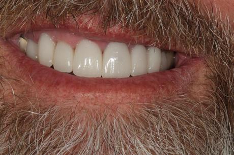 After picture of a dental veneer patient in Huntington Beach