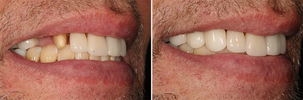 broken tooth was replace with a dental implant and cosmetic veneer