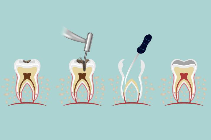 How Do I Know If I Need a Root Canal or Filling?