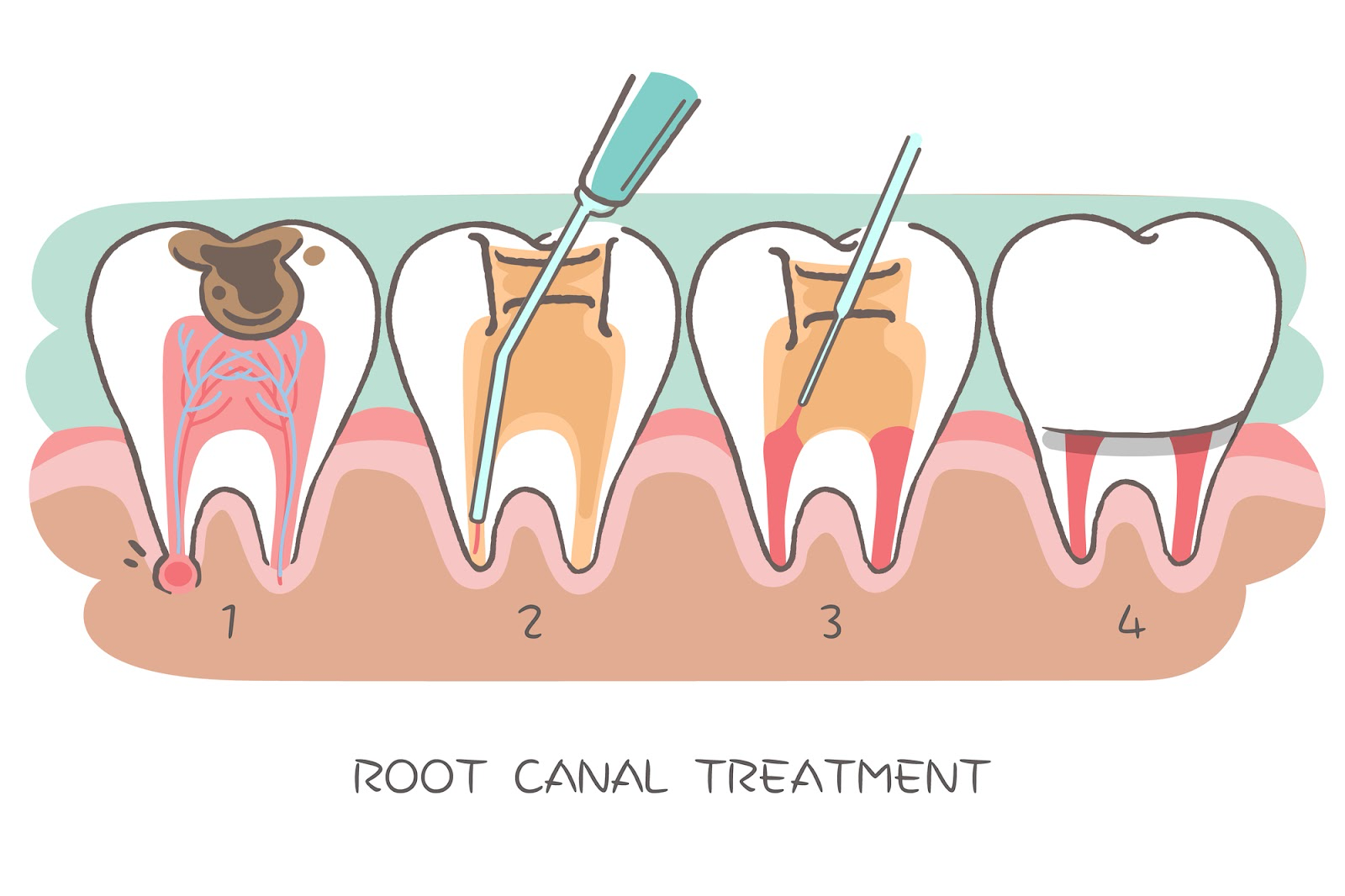 An illustration of root canal treatment in Huntington Beach, CA