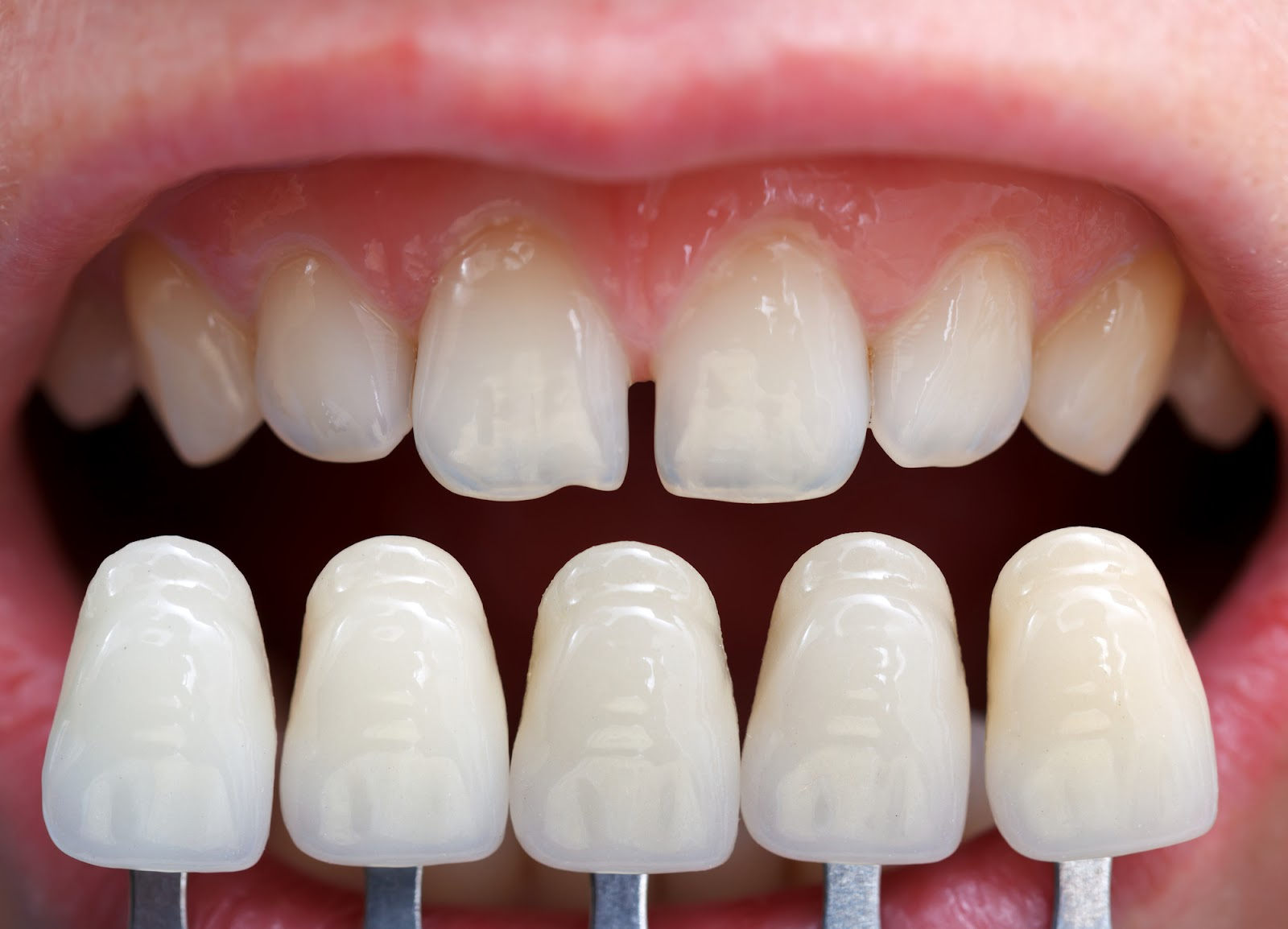 A shade guide helps a dentist in Huntington Beach match veneers to a patient's smile