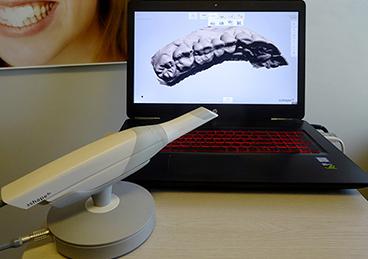 digital intraoral scanner: hi-tech dentist in huntington beach