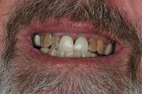 patient before dental veneers in Huntington Beach