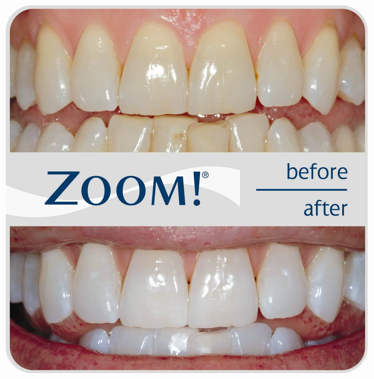 ZOOM teeth whitening in Huntington Beach